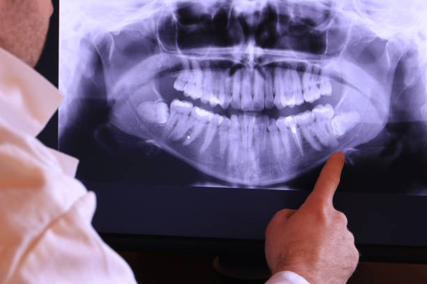 Best Emergency Wisdom Teeth Removal in Menomonie, WI